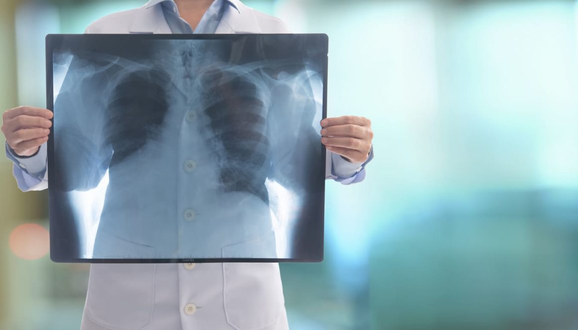 Trombo pulmonar en ancianos: ¿se hace todo lo que se puede?